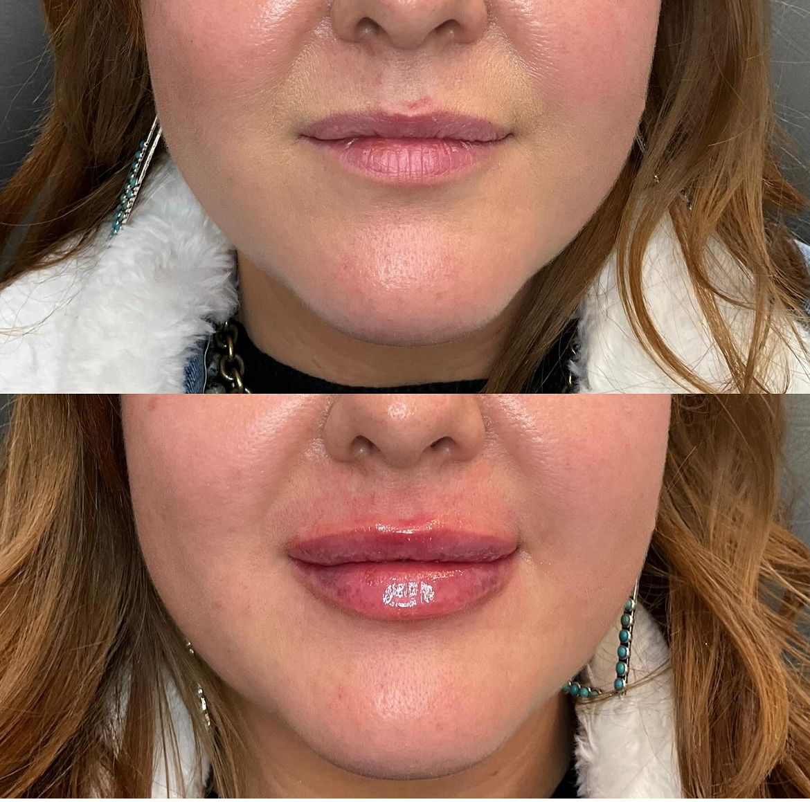 Lip Filler Before and After